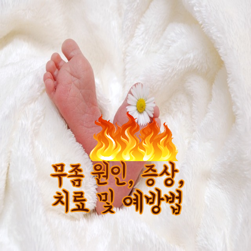 무좀 원인&#44; 증상&#44; 치료 및 예방법