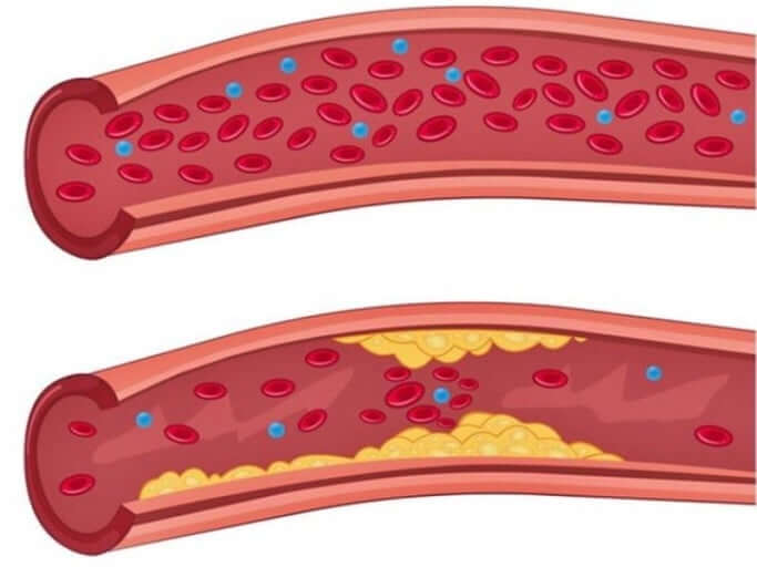 고지혈증 약의 부작용