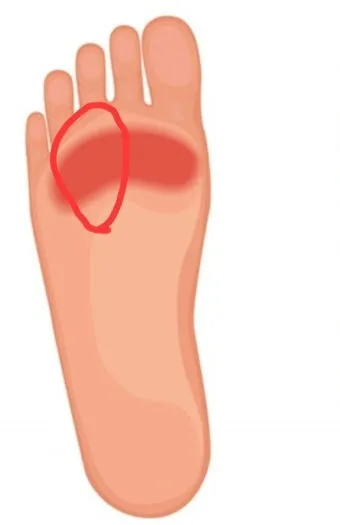 발바닥통증의 원인들과 해결책_3