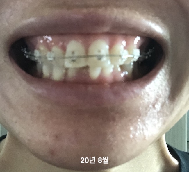 2년 7개월 교정 중 과개교합 돌출입 교정 일기