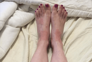 아나필락시스증세4