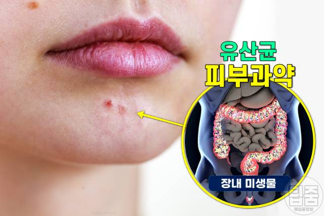 피부과 약 오래 먹으면 복용 부작용 유산균