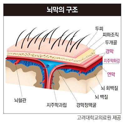 뇌졸중의 이해와 치료, 예방 전략 관련 이미지
