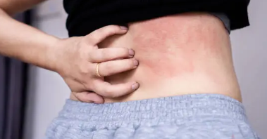 피부 붉은반점 12