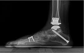 콘드리이친 효능 부작용 종류 어떤 관절 영양제 고르는 법