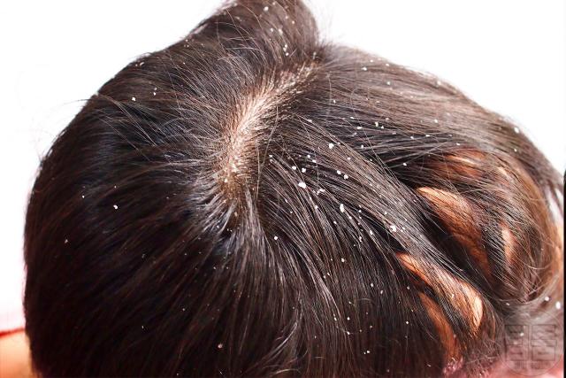 에너지드링크 부작용 카페인 두피 비듬