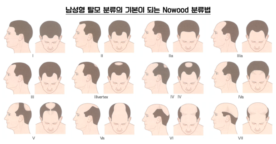 남성형 탈모는 노르우드 분류 시스템에 따라 1단계부터 7단계까지 구분
