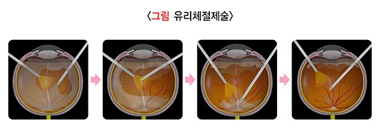 당뇨망막병증