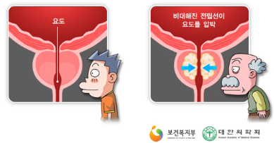 전립선비대증