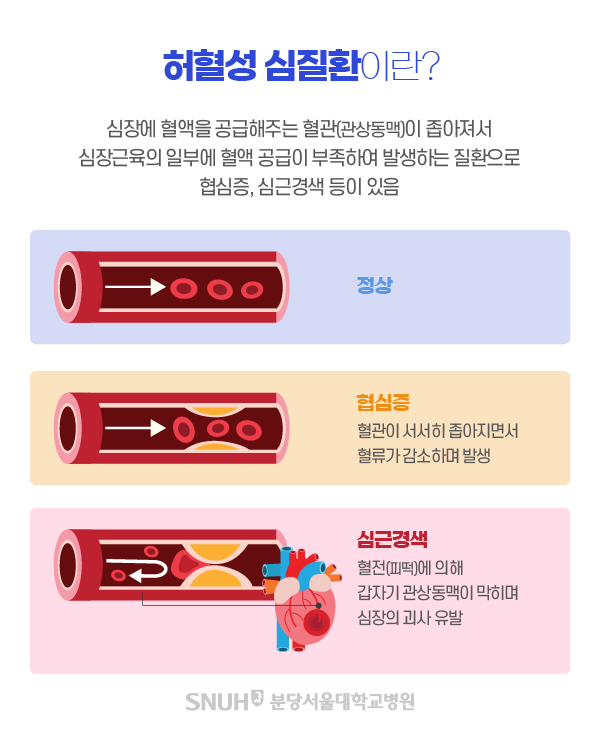 심근경색 허혈성 심질환 이미지