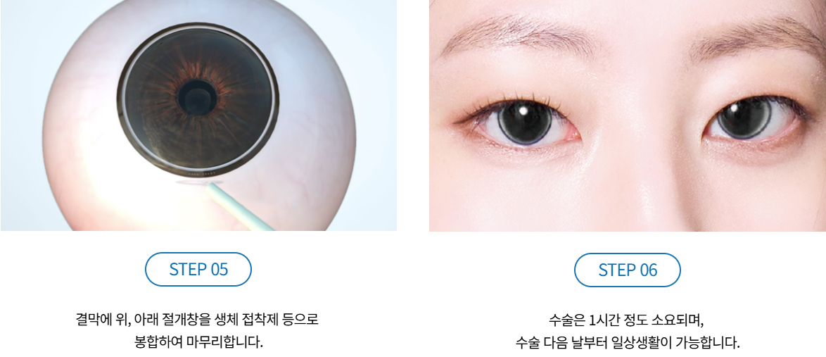 아이링수술, 아이링수술후기, 써클렌즈 대체, 눈동자확대수술, 미용성형, 안과 시술, 렌즈부작용