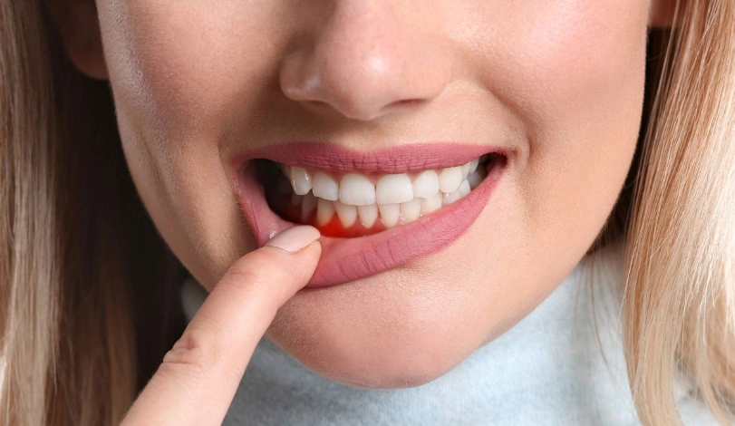 치주병 원인 증상 진행과정 치료 예방법 정리