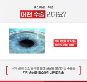 스마일라식