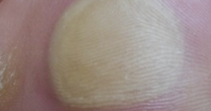 발 물집 생기는 이유2