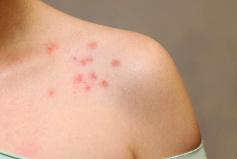 빈대에 물린 환부