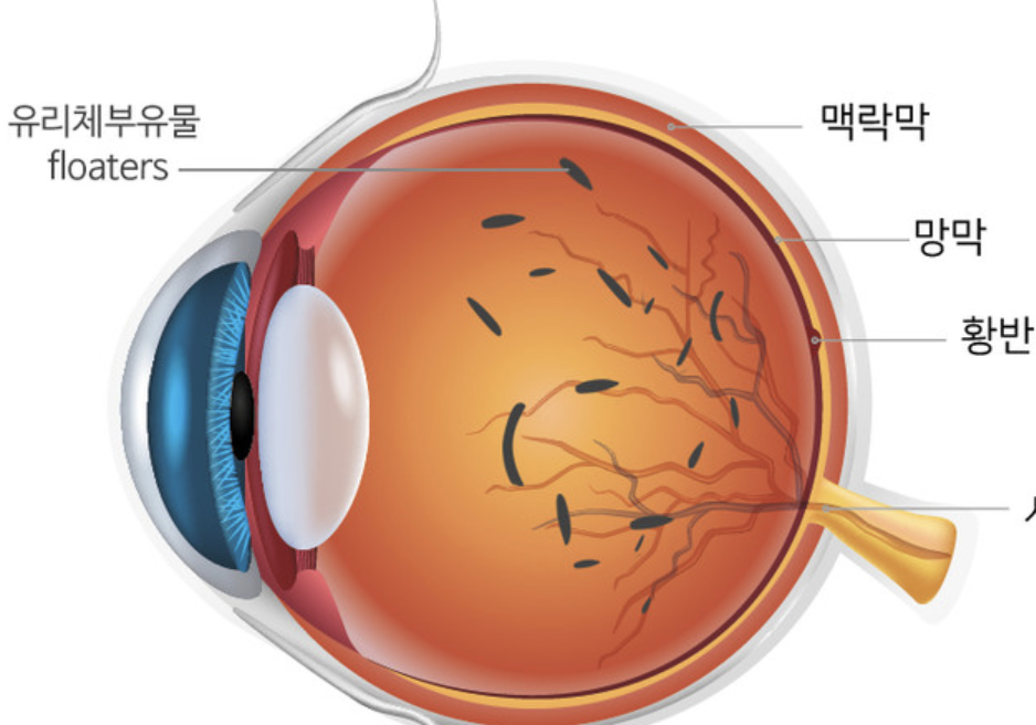 비문증 치료방법 6가지, 원인 섬네일