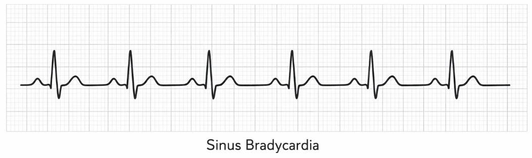 동성서맥(Sinus Bradycardia) 심전도 파형 예시, 규칙적이지만 느린 심박 리듬