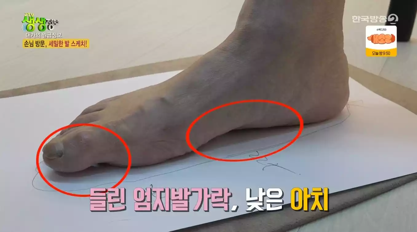무지외반증 발