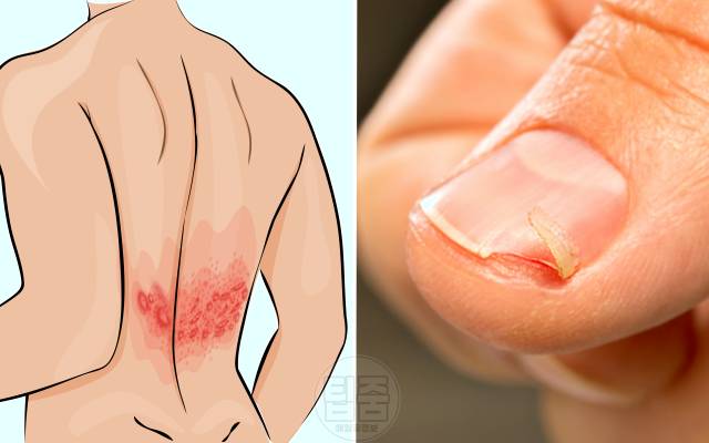 피부병 포진서잎부염 손톱 글루텐과민증