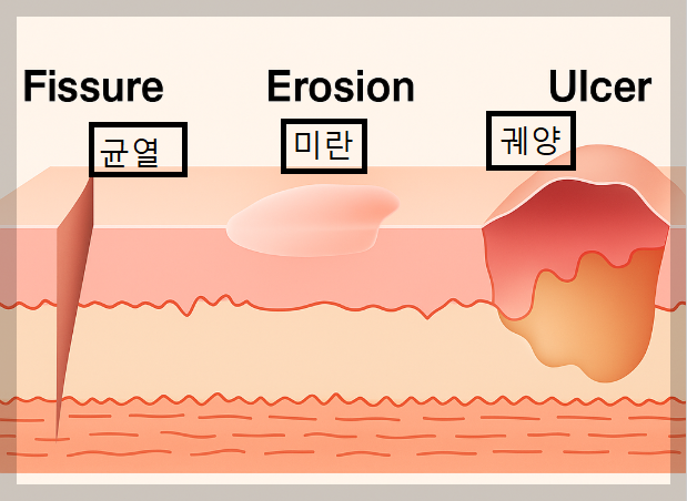 함몰 피부병소 균열, 미란, 궤양