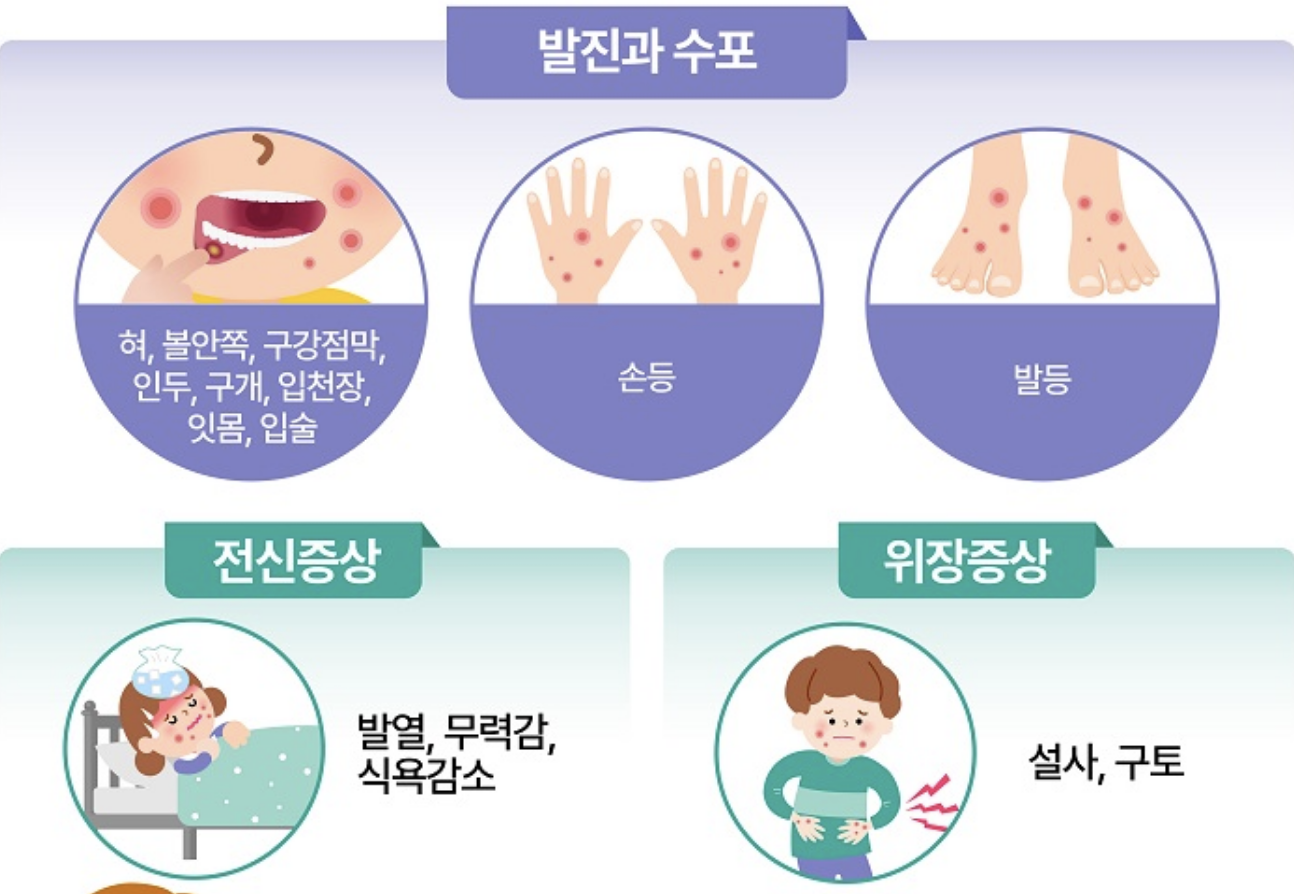 수족구병