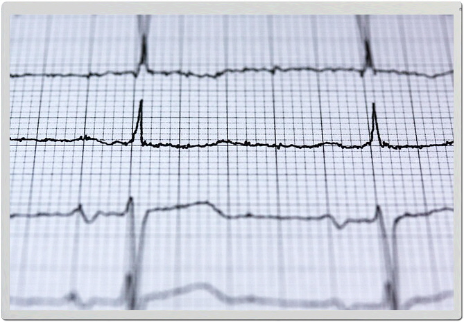 심근경색-심전도검사