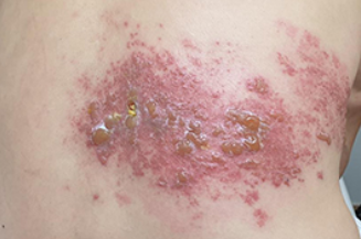 대상포진흉추부위