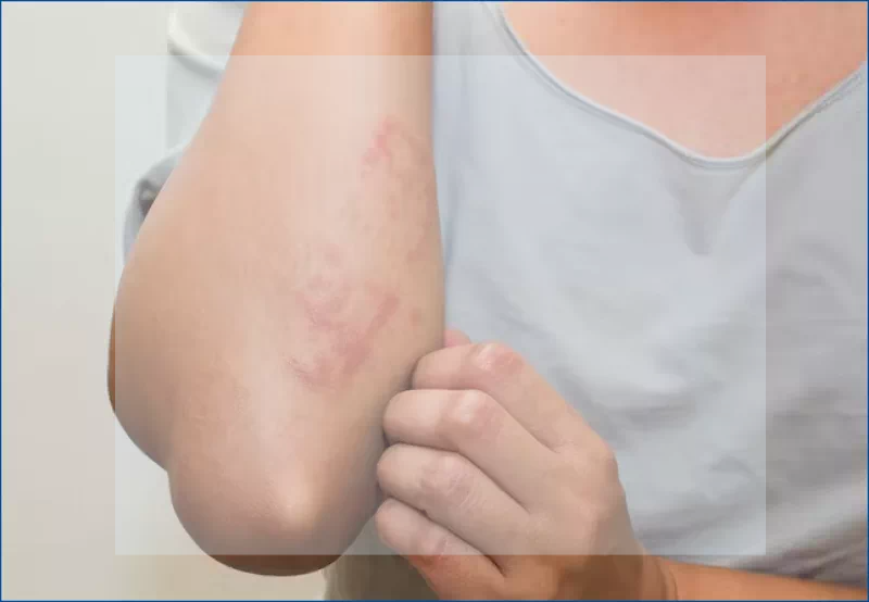 피부 두드러기