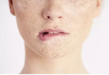 얼굴 검버섯 없애는 방법