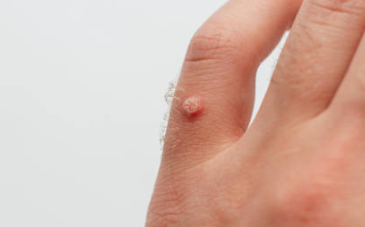 사마귀 제거방법 연고 추천 사마귀 냉동치료 원인 실비보험