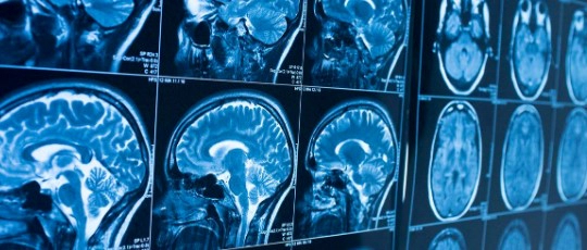 뇌암 초기증상 치료방법 및 김정화 남편 뇌암 사연