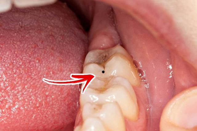 충치 증상 검은점