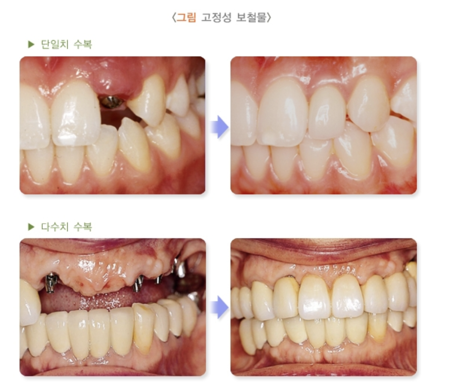 고정식 보철물