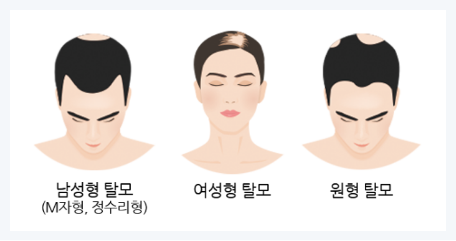 탈모의 종류
