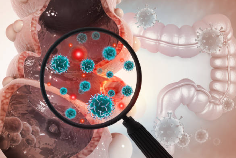 대장암과 관련된 사진3