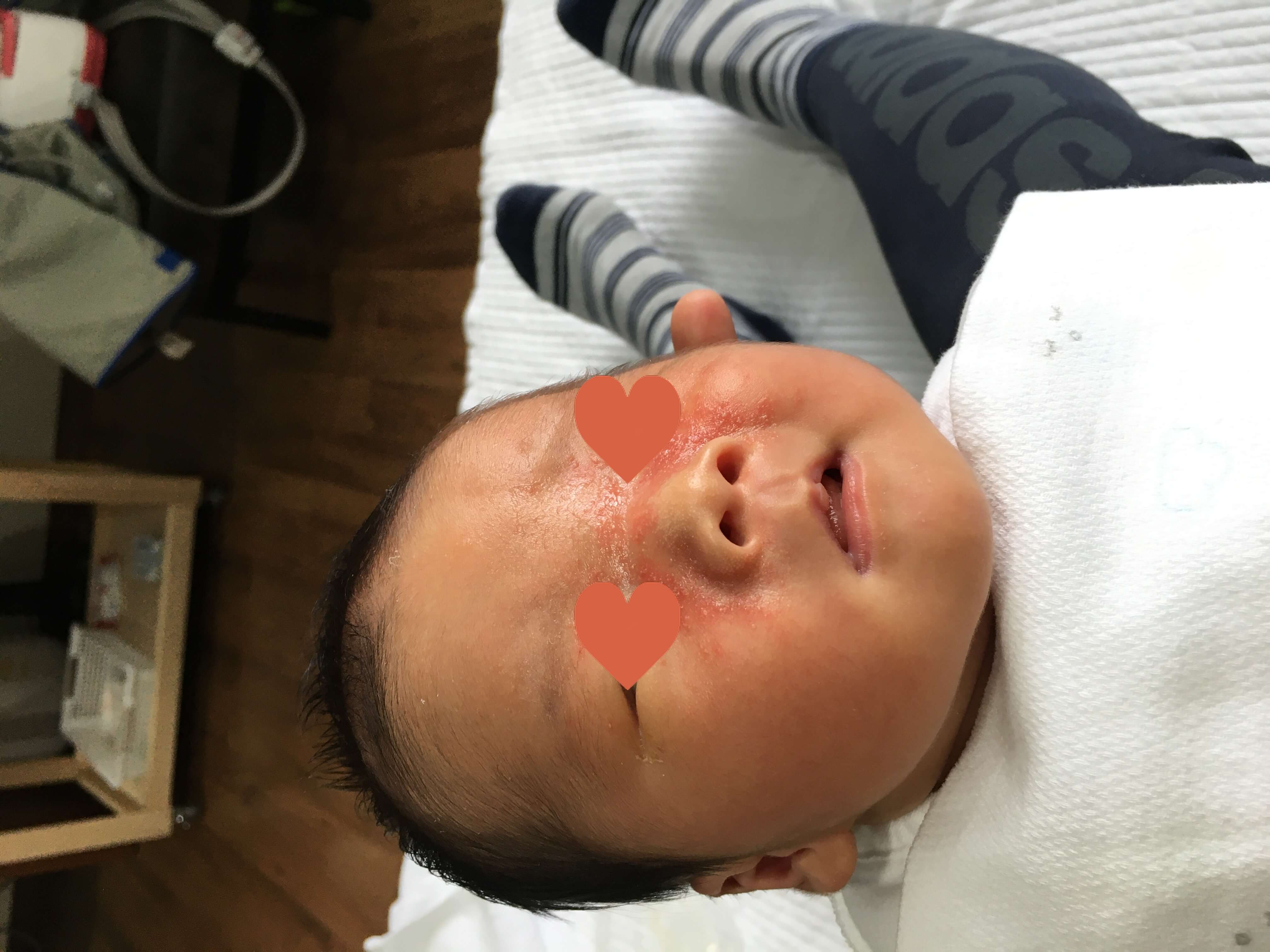 영유아 아토피 치료후기(ft.제로이드)-태열