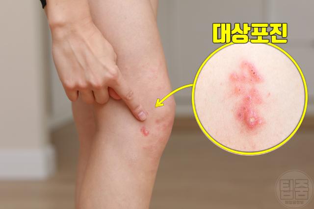피부 따끔거림 대상포진 증상
