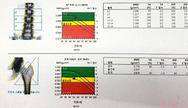 골밀도 검사 정상수치