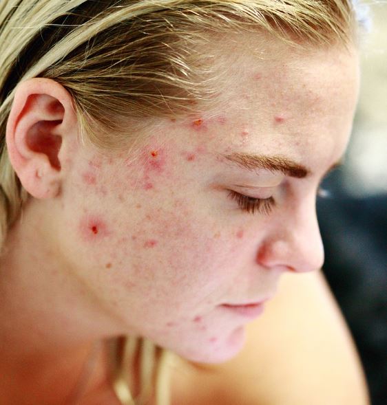 여드름 빨리 없애는 법 원인 증상