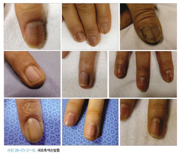 발톱세로선_흑색종
