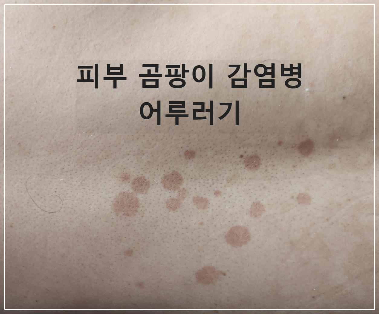 어루러기