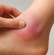 발목 접질렀을때