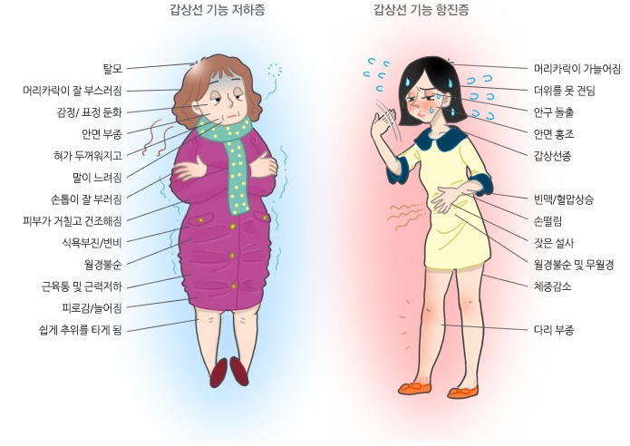 갑상선 저하증과 항진증 증상 비교 이미지