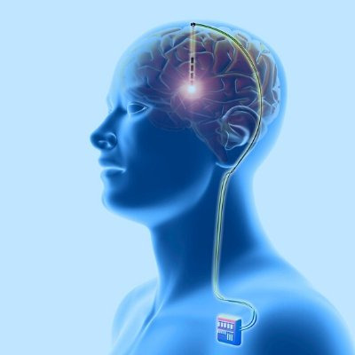 파킨슨병 파킨슨병증상 L도파 도파민 파킨슨병재활