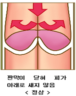 하지정맥류-다리가-붓는-이유