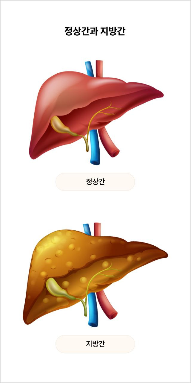 지방간 정상간 비교