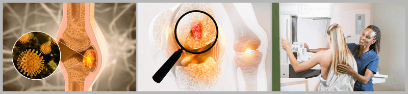 골육종 보험 진단