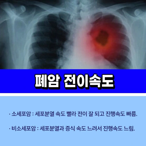 폐암 전이 속도