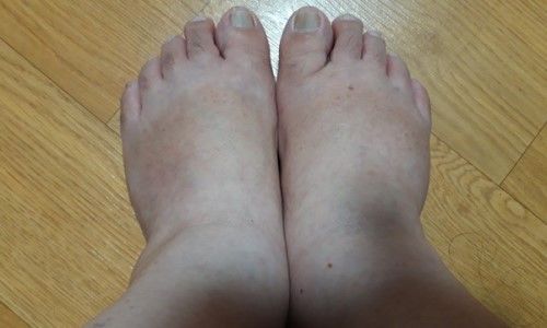 발등이 부어오르는 이유