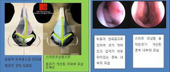 비중격 교정술 증상 및 진단 방법